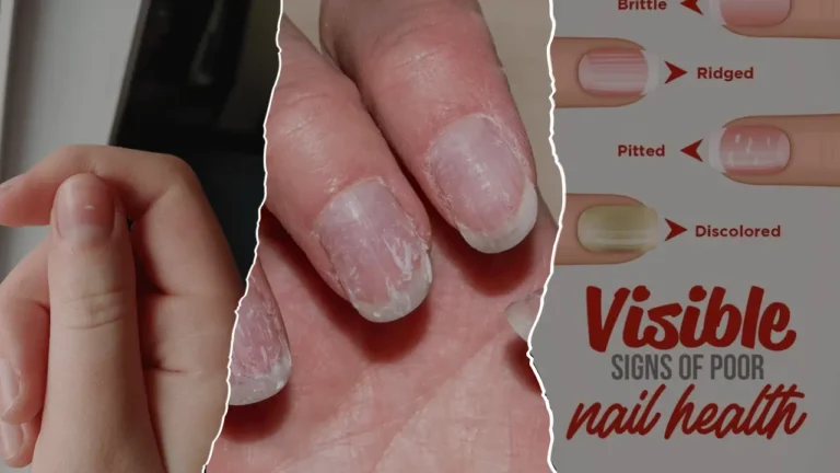 White spots or white marks on nails often catch attention because they appear suddenly